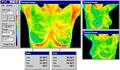 Digital Infrared Thermal Images of Breast Area - Meditherm