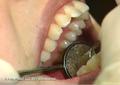Symptoms of Gum Disease