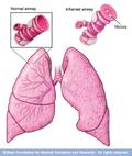 Illustration of what happens during an asthma attack
